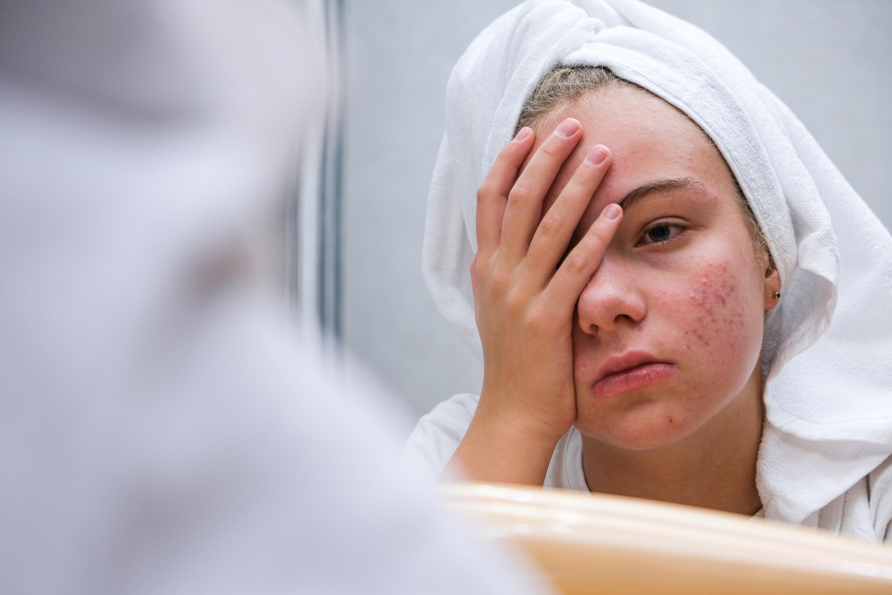 Acne bij tieners in de puberteit